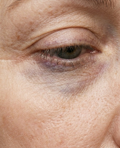 Dark Circles