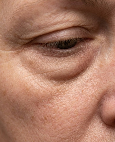 Puffiness & Eye Bags