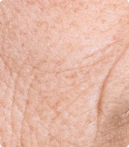 Fine Lines & Wrinkles